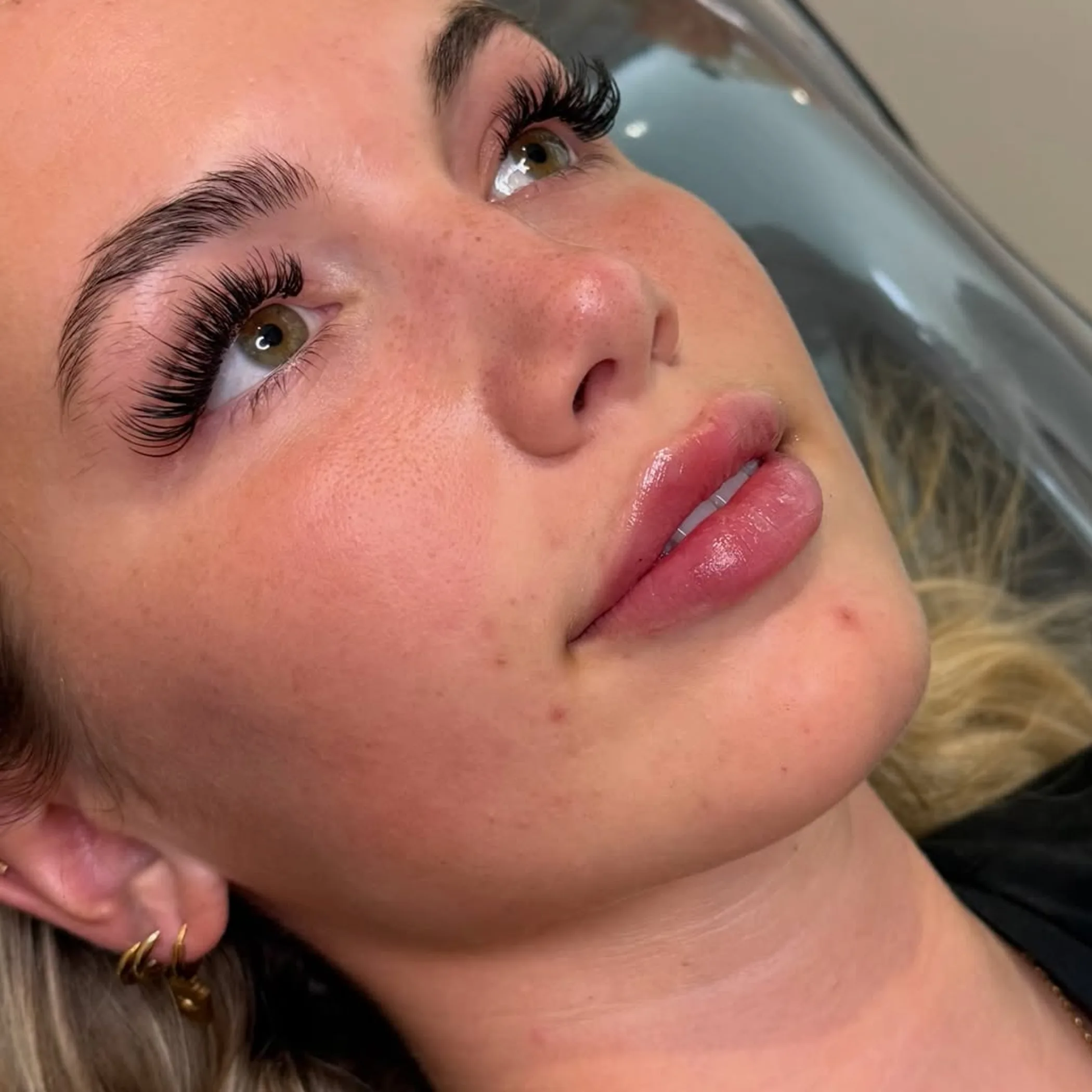 close-up of lips with filler